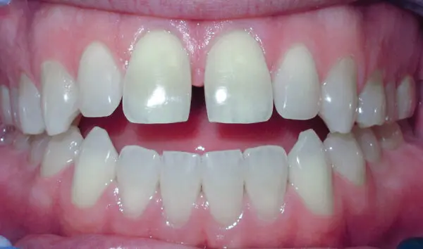 Patient with spacing and an anterior openbite