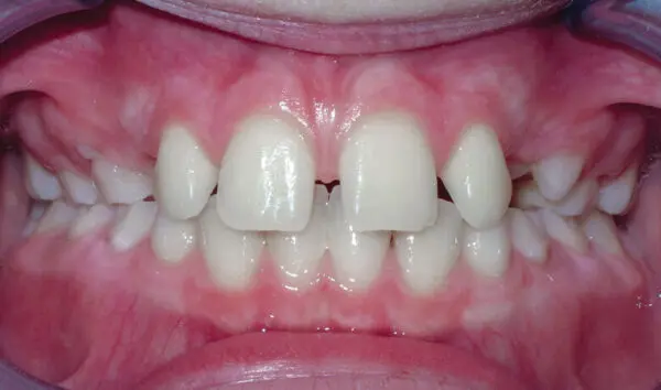 Patient with spacing and an overbite