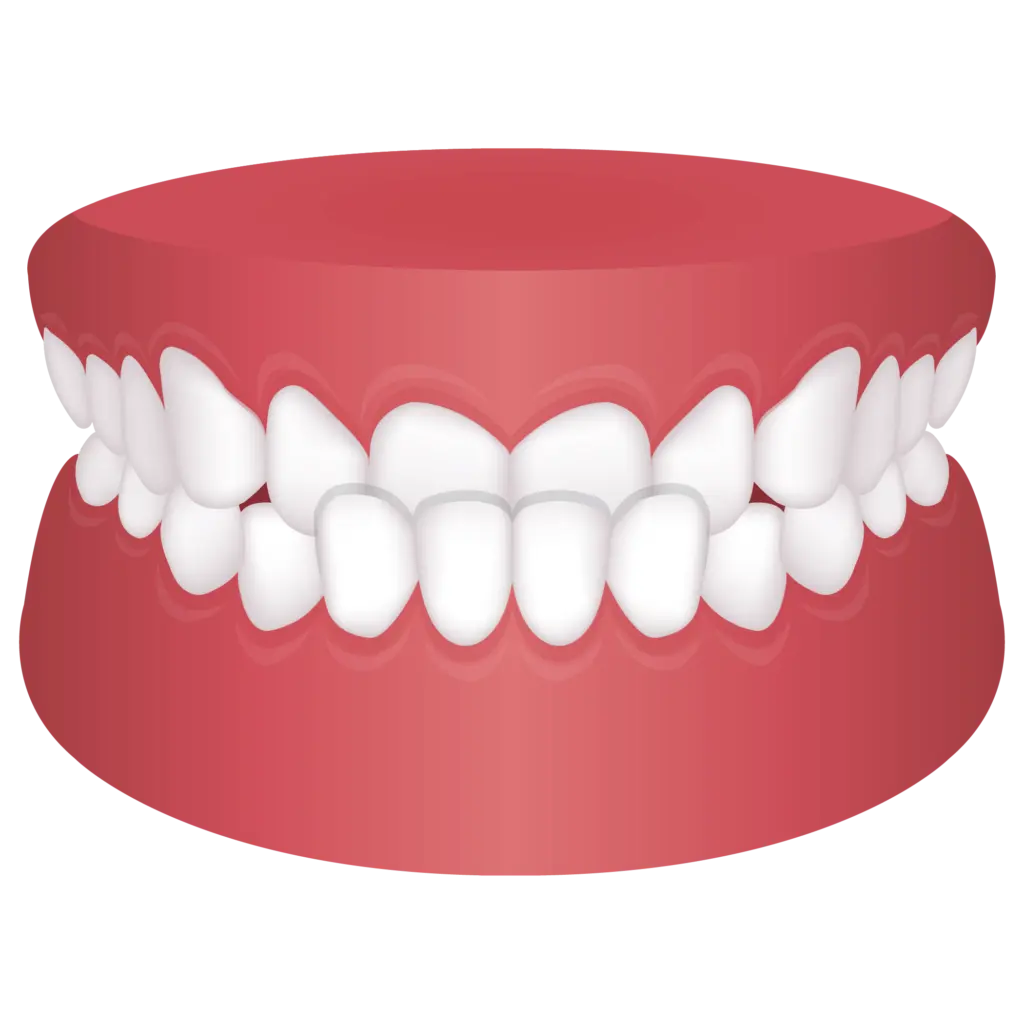image of Underbite