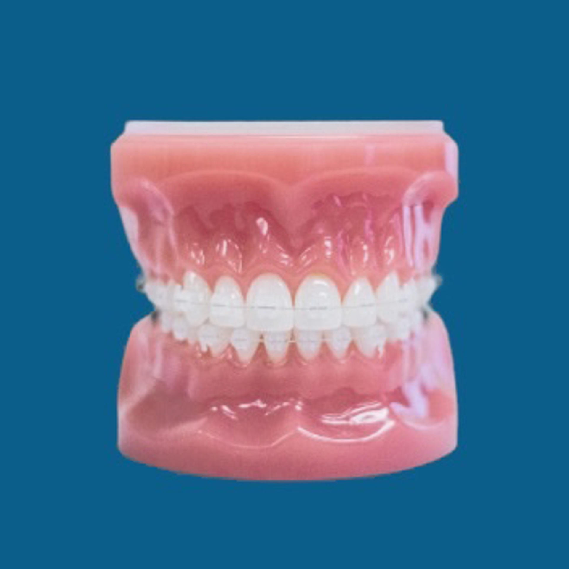 tooth model with ceramic braces