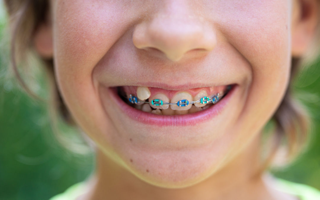 Can You Have Braces with Missing Teeth?