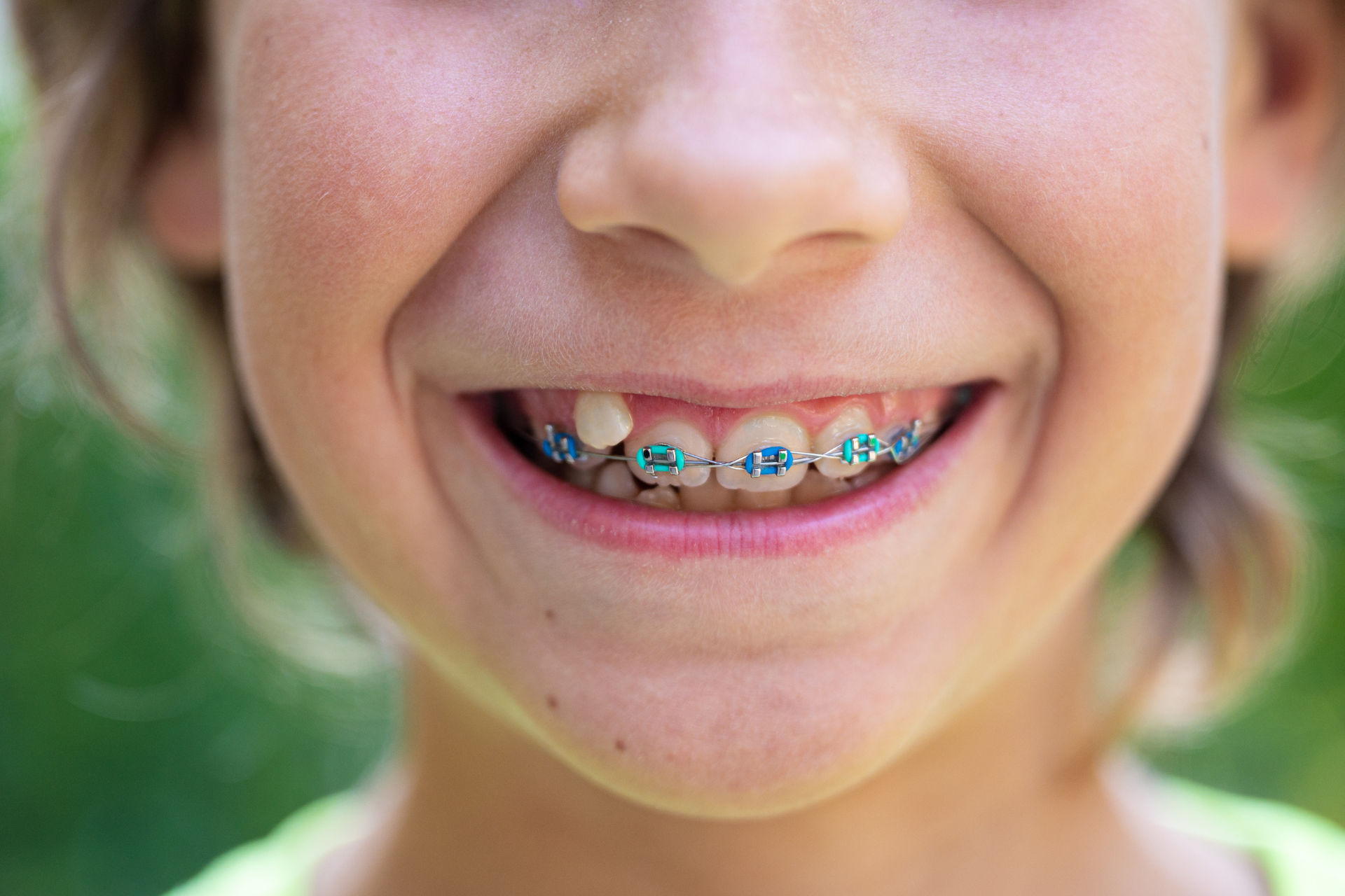 kid with blue braces and missing teeth