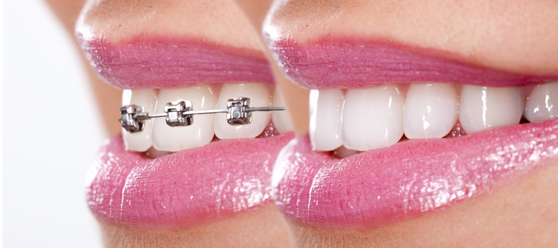 Who provides affordable braces in Asheville?