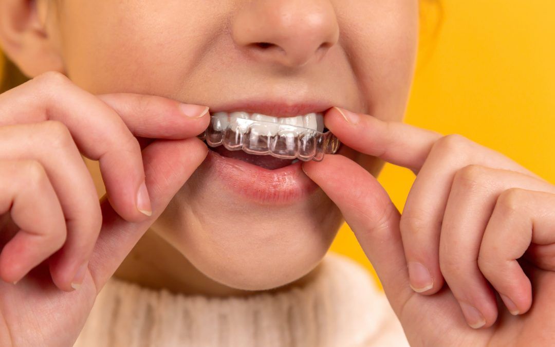 Invisalign Braces Price