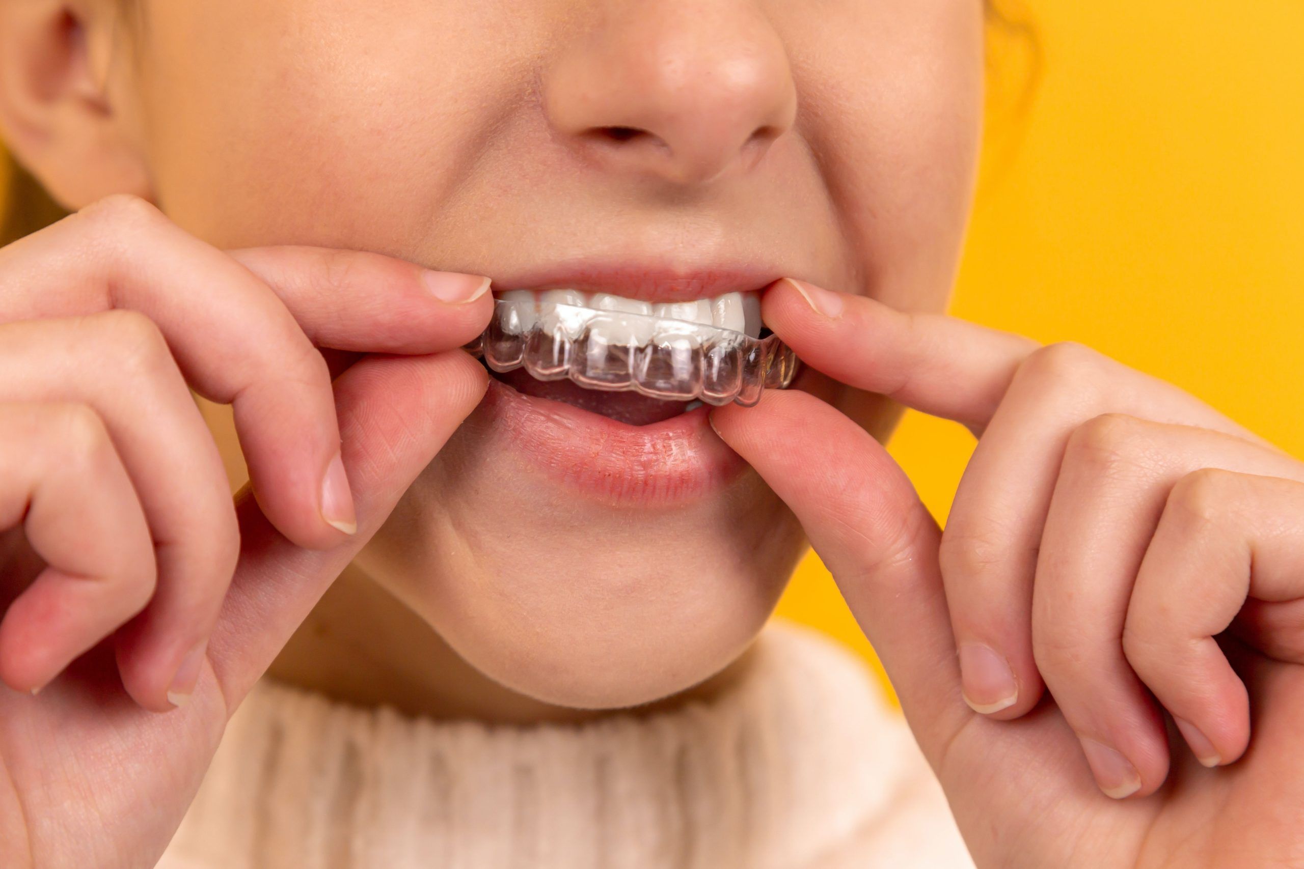 Who offers the fastest Invisalign treatment in North Asheville?