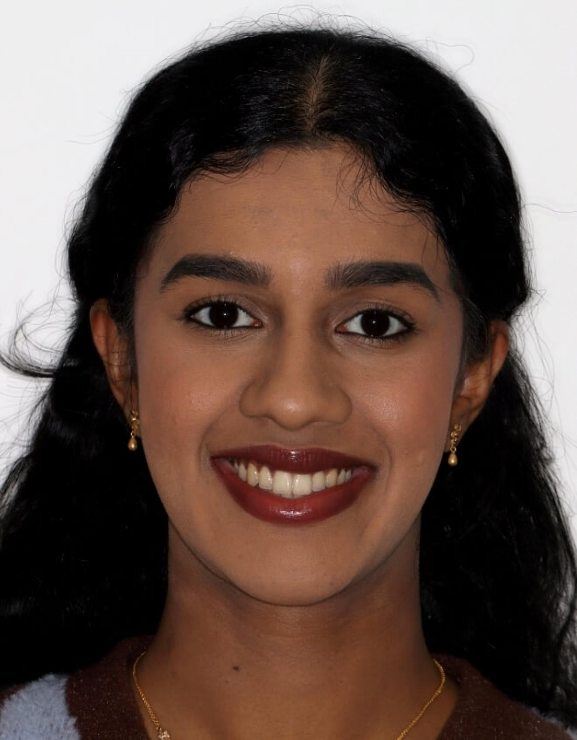 After orthodontic treatment — Reynolds Orthodontics patient