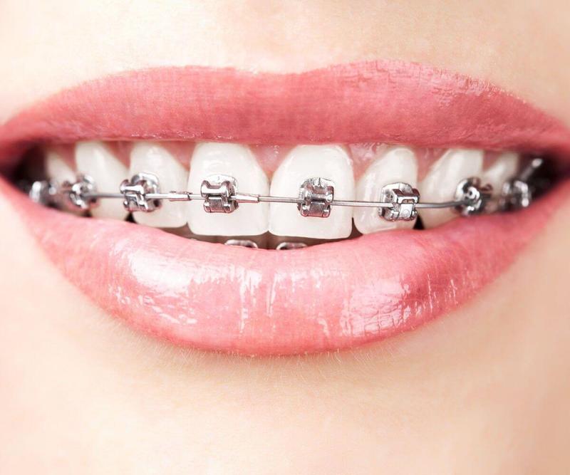 Close-up of teeth with metal braces