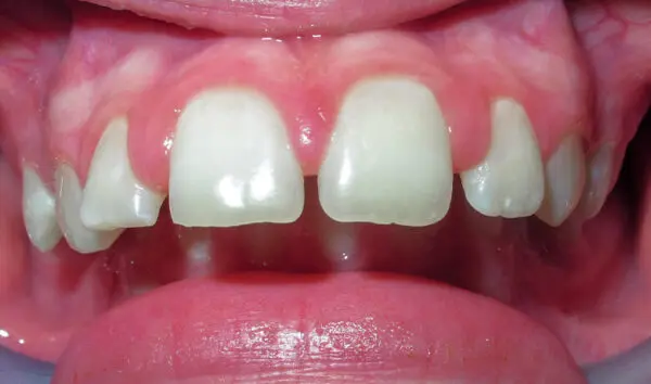 Patient with an overbite, spacing and protrusion