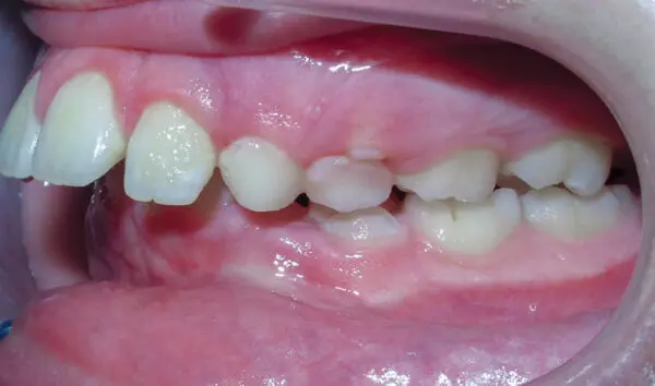 Patient with an overbite and protrusion