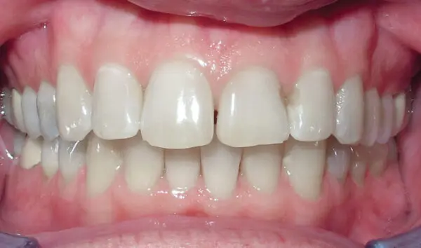 Patient with an overbite