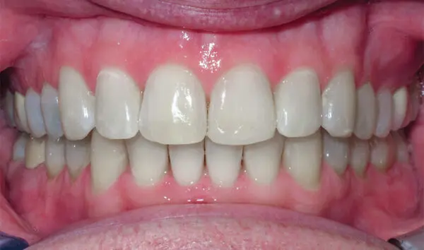 After Smile Transformation