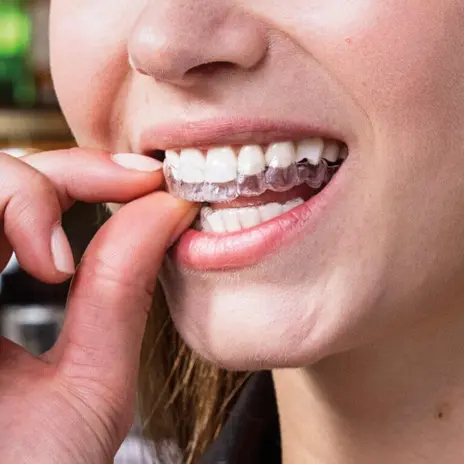 invisalign clear aligners