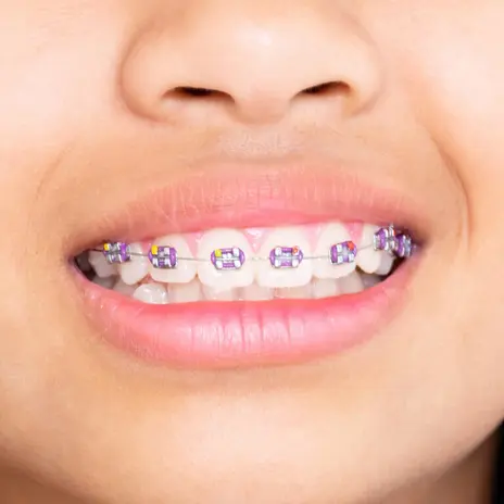 braces