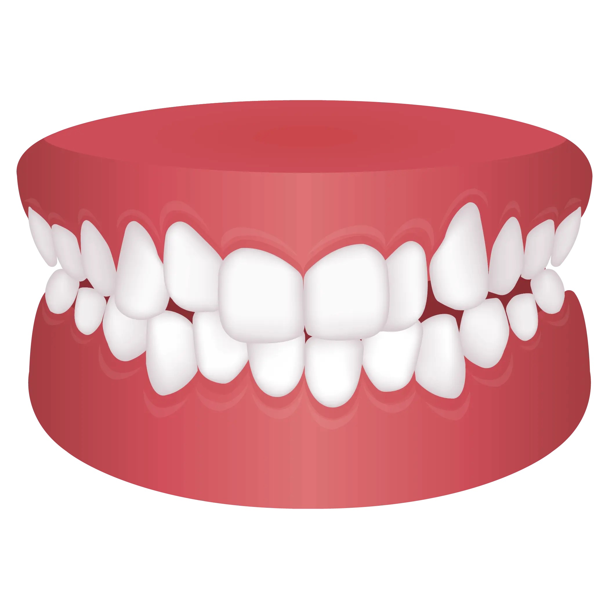 image of Teeth crowding