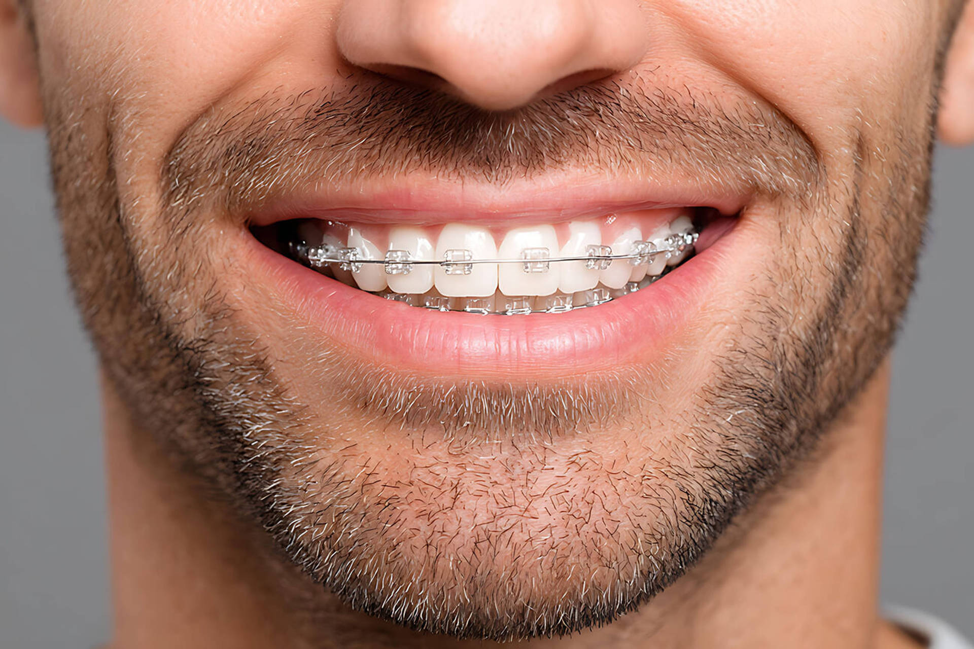 Close up of adult man smiling proudly with ceramic braces symbolizing orthodontic treatment