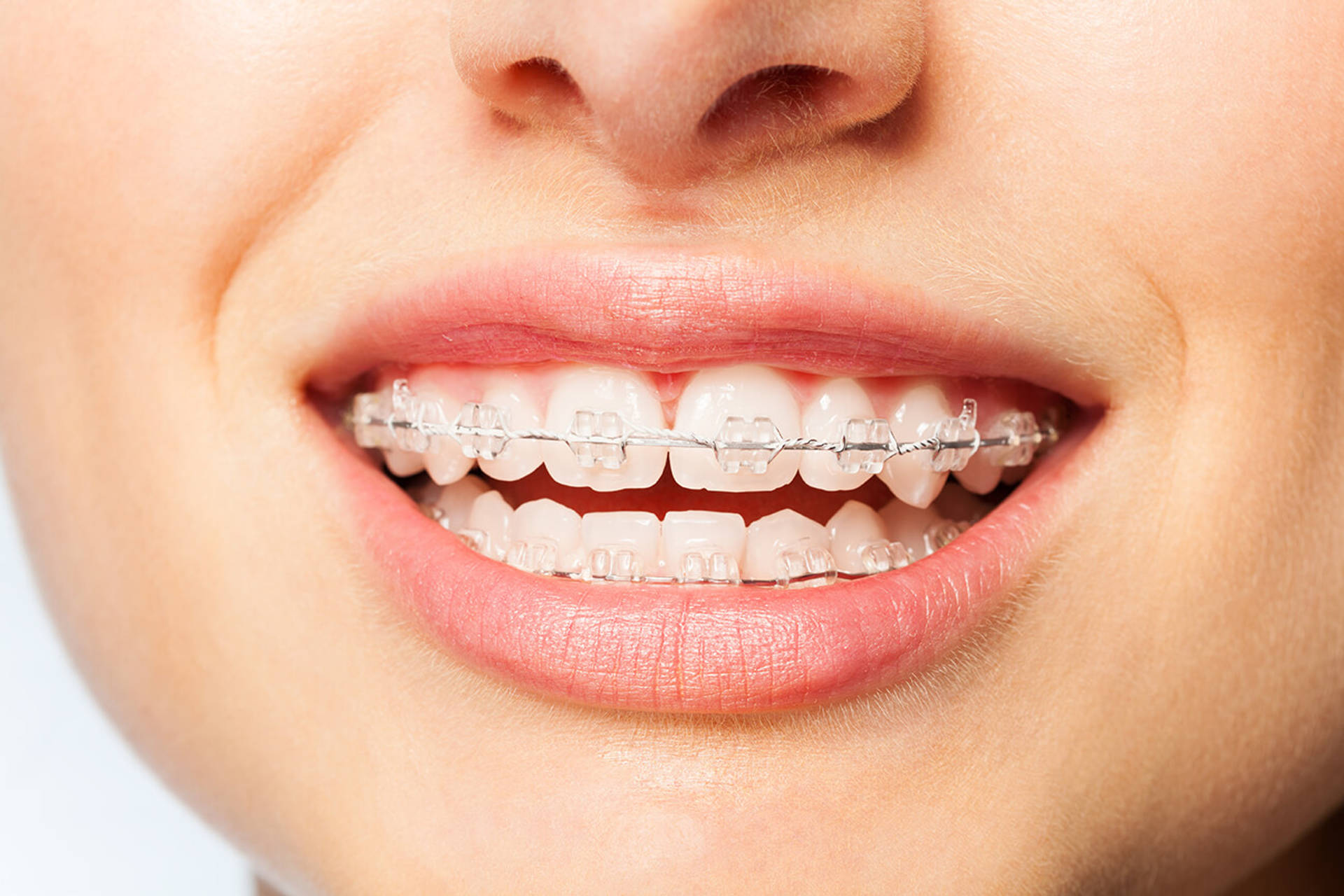Healthy smile woman with clear brackets 