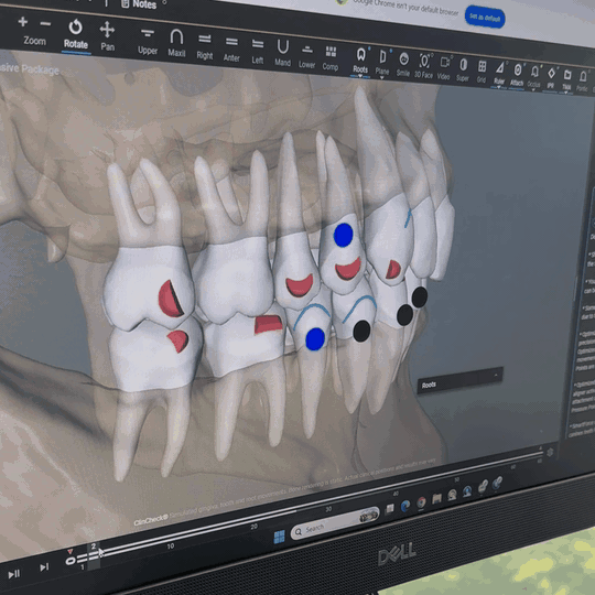 Animated 3D scan of a patient's teeth and roots with attachments marked on the Brown + Co treatment monitor