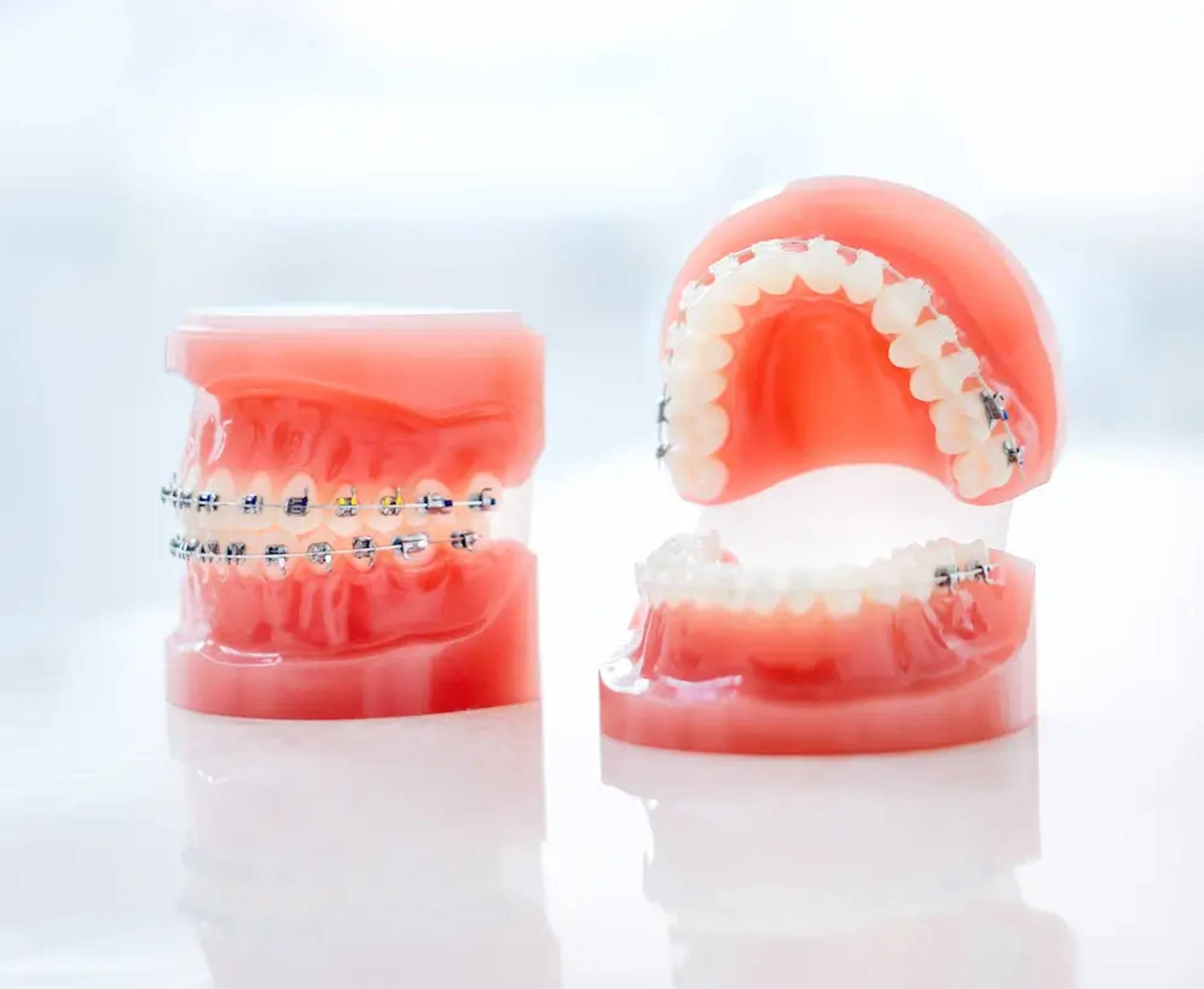 metal and ceramic braces on teeth models