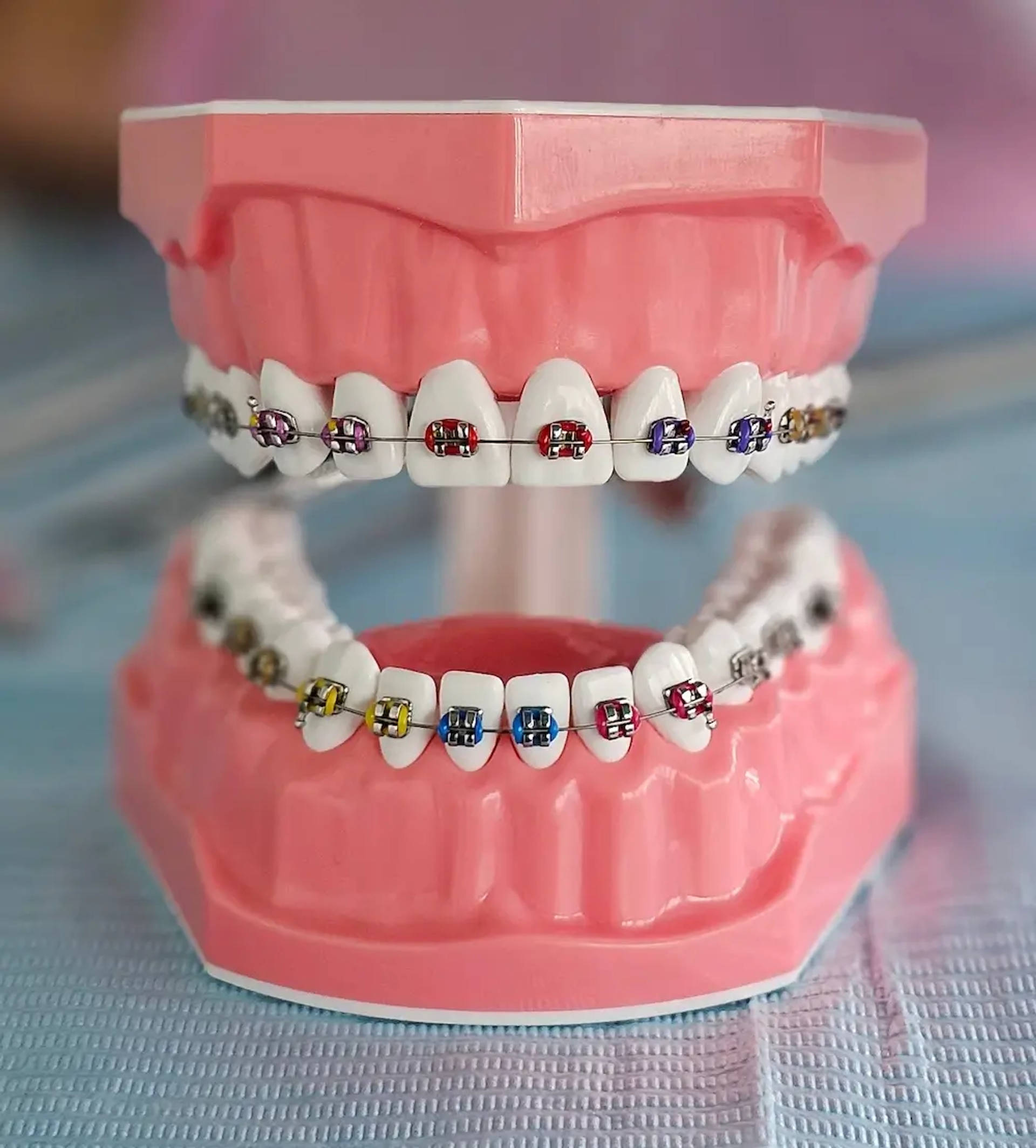 colored braces