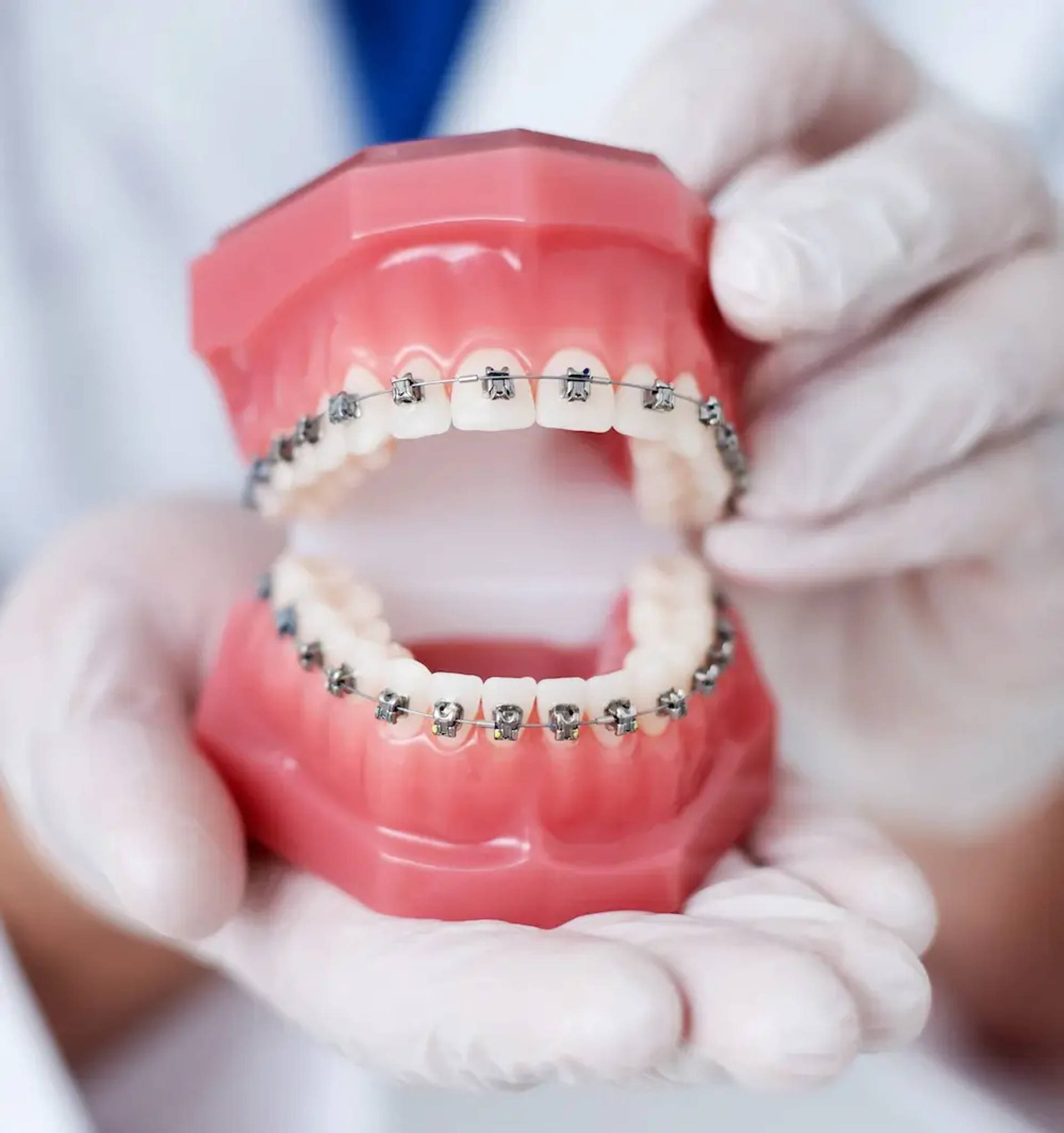 metal braces