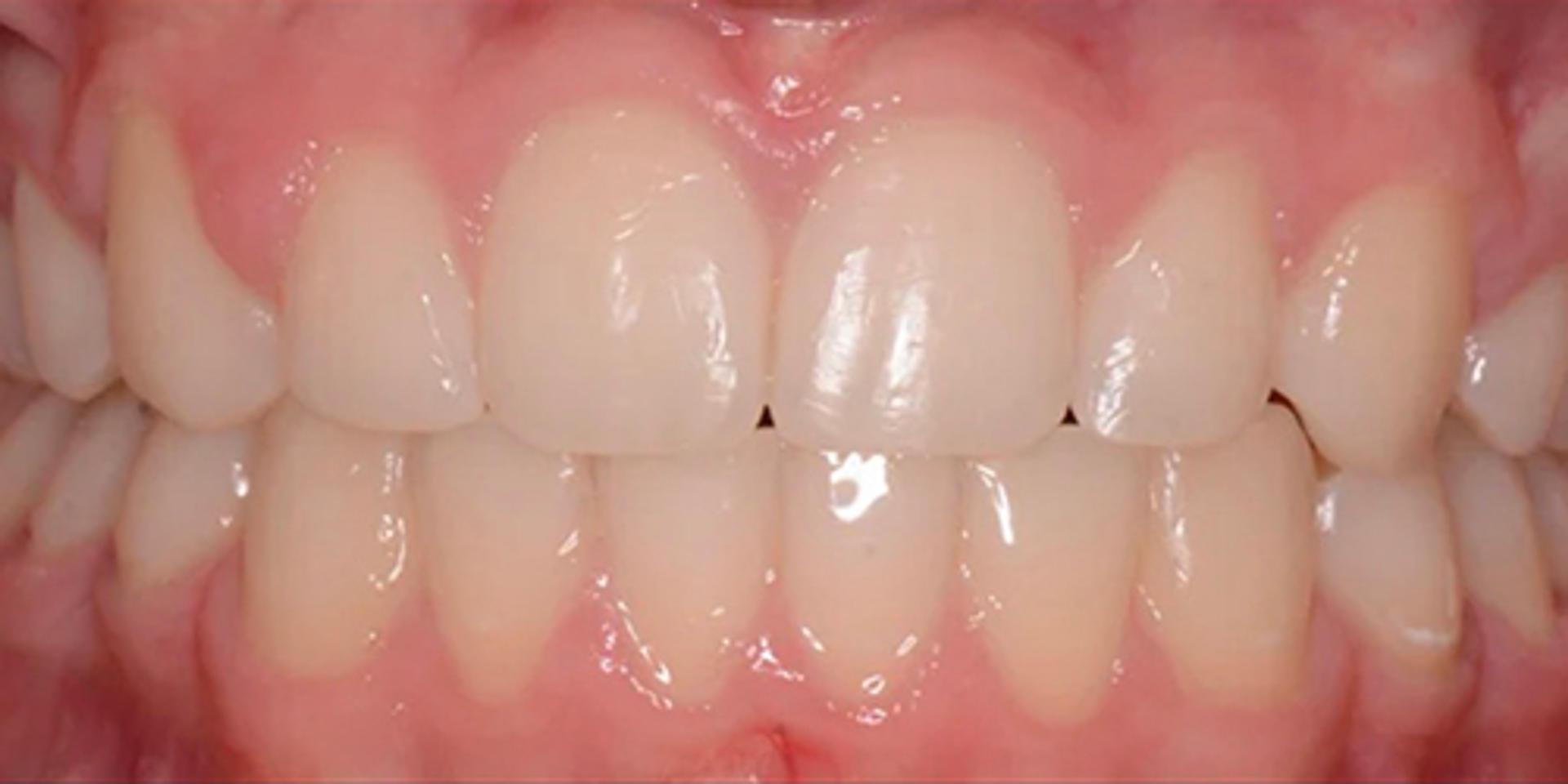 case 04 after