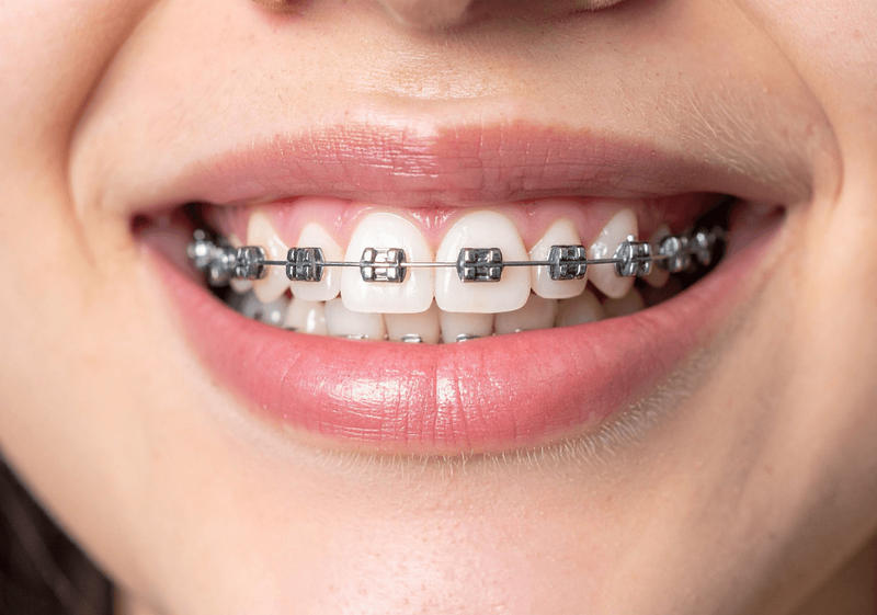 Close up smiling woman with braces
