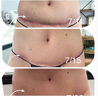 Lymphatic Express Before and After - Cosmetic Surgery Photo Album