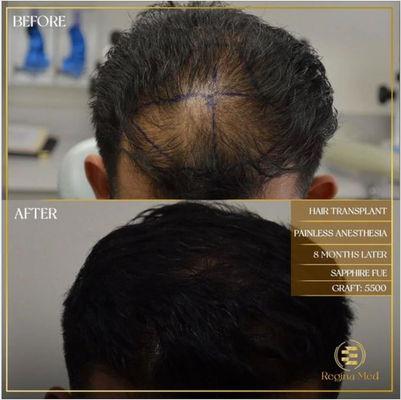 Regina Med Aesthetic Hair Transplant - Cosmetic Surgery Photo Album By Regina Med Aesthetic Regina Med Aesthetic Hair Transplant - Cosmetic Surgery Photo Album By Regina Med Aesthetic