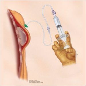 Tissue-Based-Breast-Reconstruction