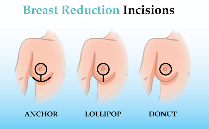 Breast reduction dubai incision types