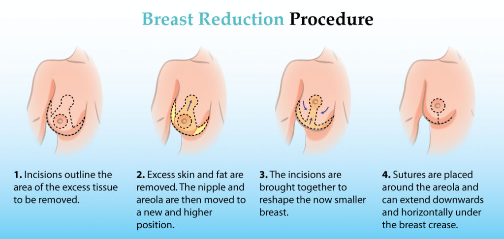 breast-reduction-dubai