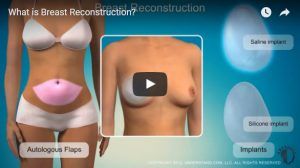 breast-reconstruction-video