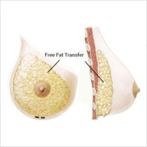 Fat-Grafting-Breast-Reconstruction