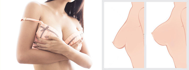 breast-implants-dubai