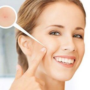 Acne Scar Treatment in Dubai