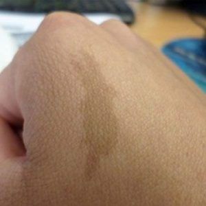 Birthmarks Treatment