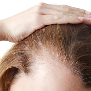 Female Hair Transplant
