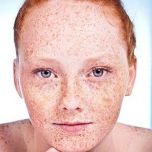 Freckles and Blemishes