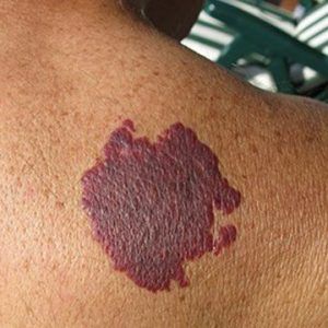 Port Wine Stains Treatment