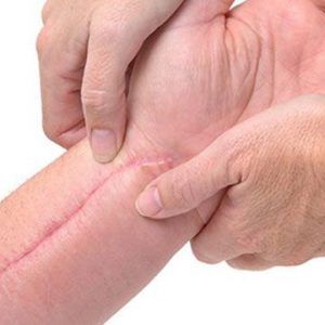 Post Surgical Scars