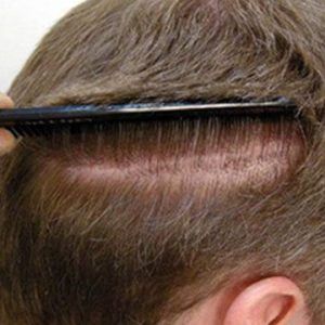 Strip Hair Transplant