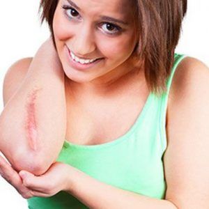 Surgical Scar Revision