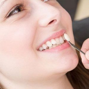dental-veneers