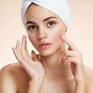 acne treatment