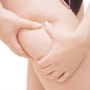 Cellfina Skin Treatment for Cellulite