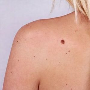 mole removal