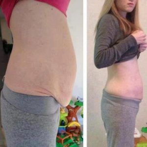 Post Weight Loss Treatment