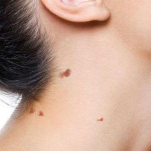 skin tag removal
