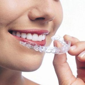 Invisalign braces