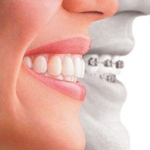 Orthodontic Treatment in Dubai/Abu Dhabi